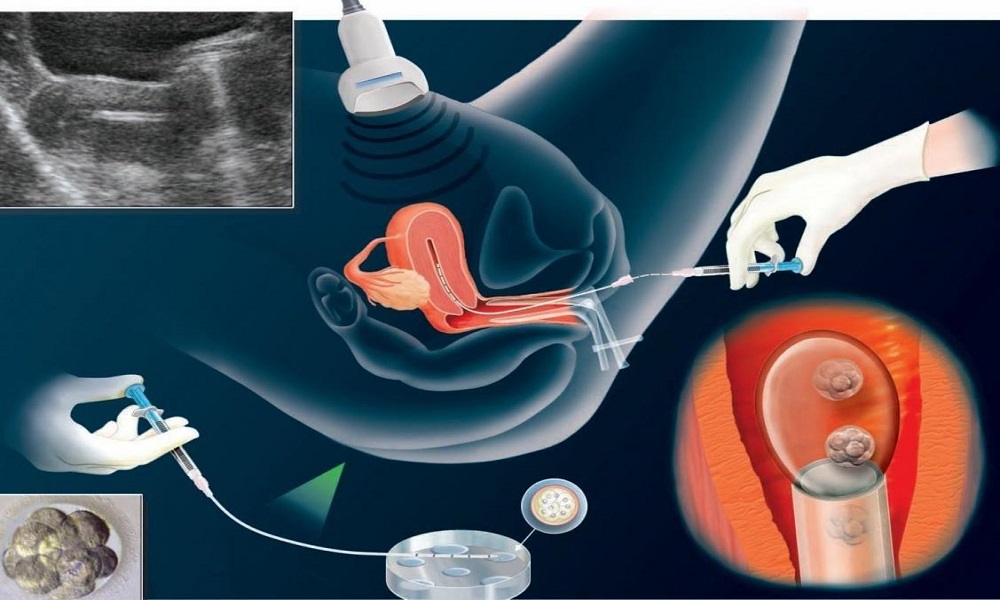 Ин Витро (IVF): ембрио трансфер