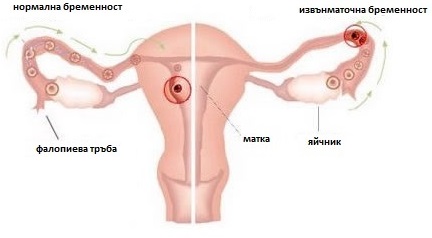 Глава 19: Извънматочна бременност : Симптоми и признаци на извънматочната бременност